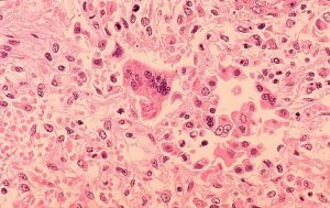 Photo of measles under a microscope